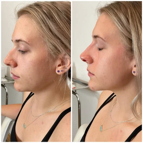 Injectable treatment results 1